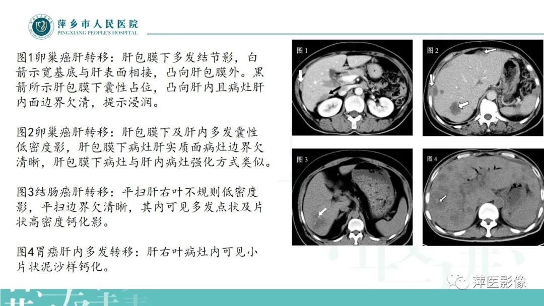影像PPT - 【PPT】寻根问底—肝转移瘤-28