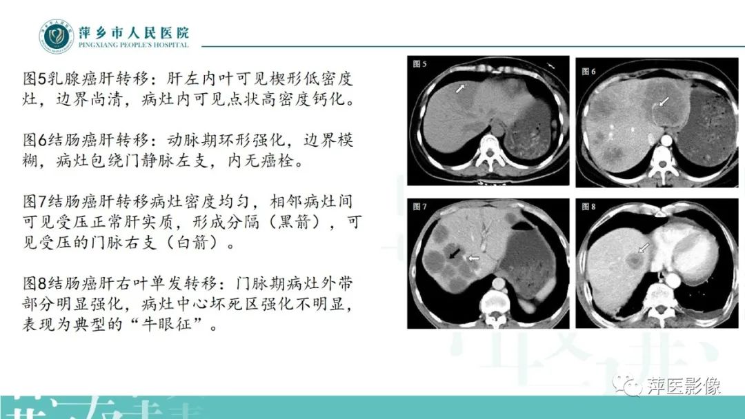 影像PPT - 【PPT】寻根问底—肝转移瘤-29