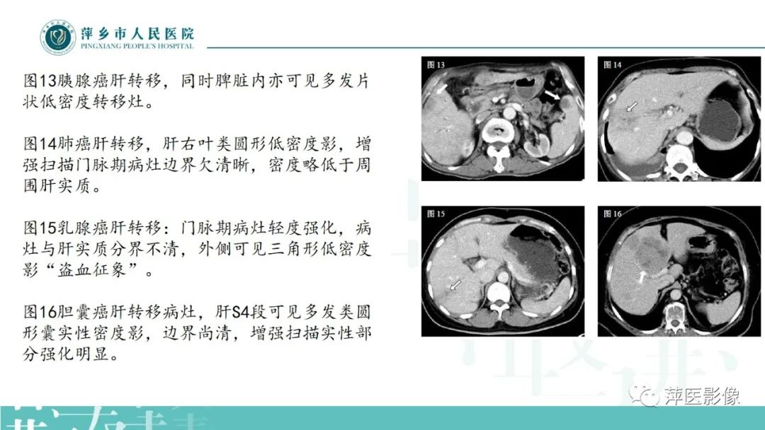 影像PPT - 【PPT】寻根问底—肝转移瘤-31