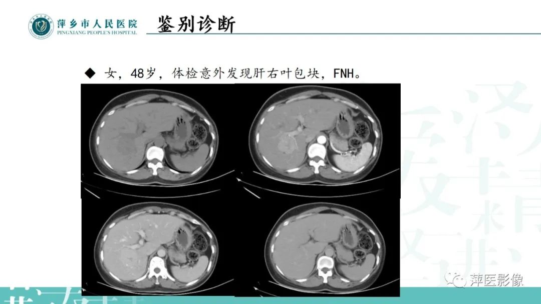 影像PPT - 【PPT】寻根问底—肝转移瘤-33