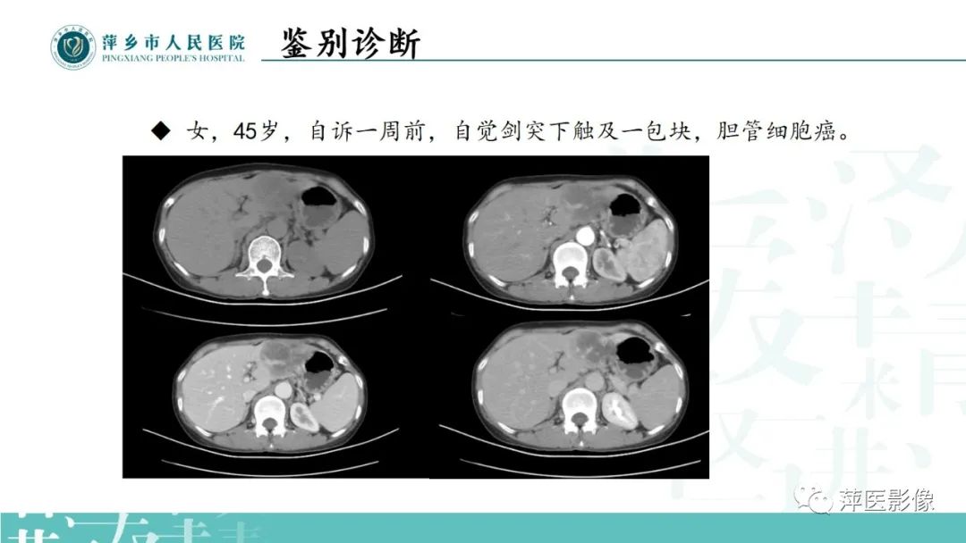 影像PPT - 【PPT】寻根问底—肝转移瘤-34