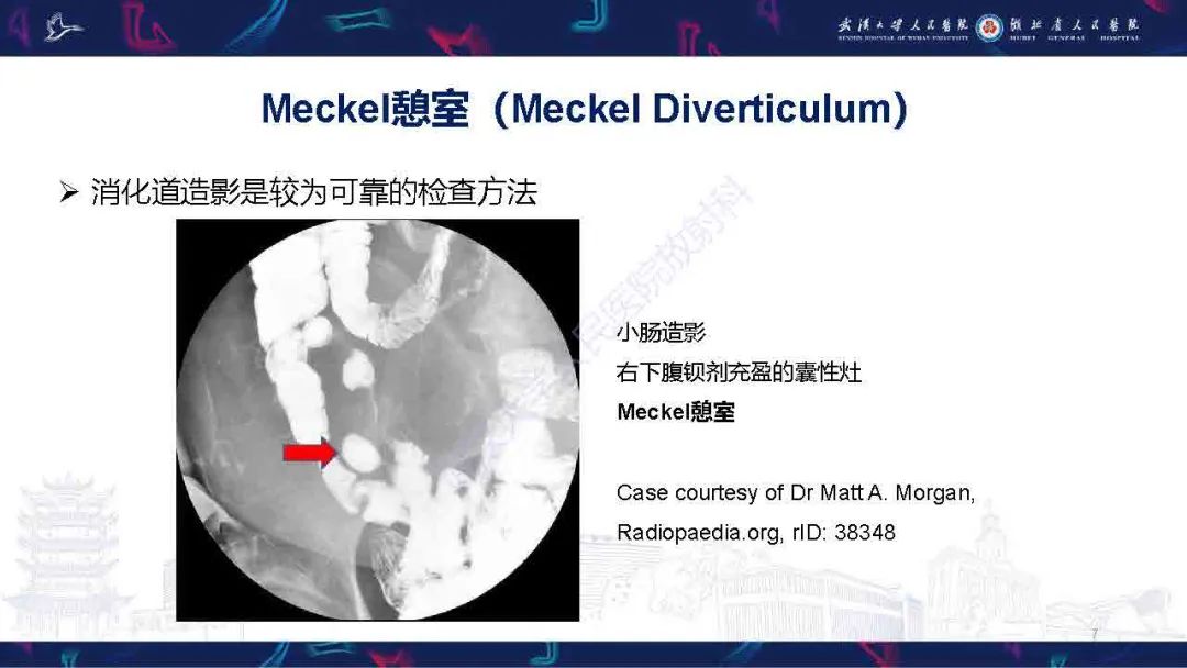 影像PPT - 【PPT】成人先天性回肠异常影像诊断-7