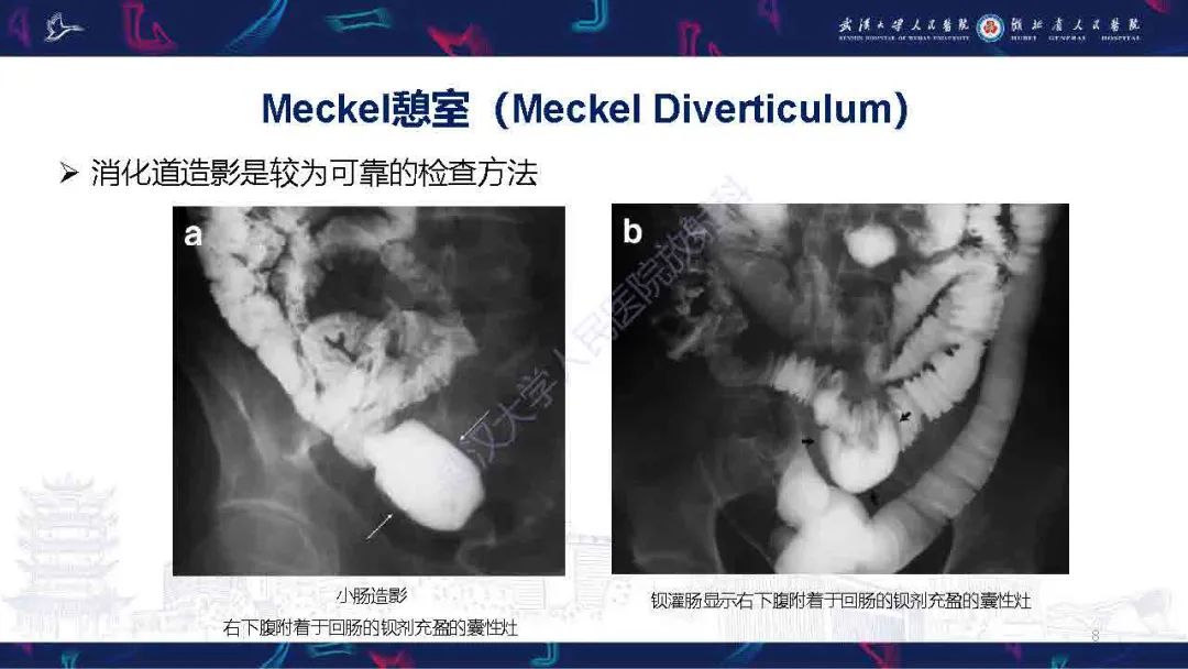 影像PPT - 【PPT】成人先天性回肠异常影像诊断-8