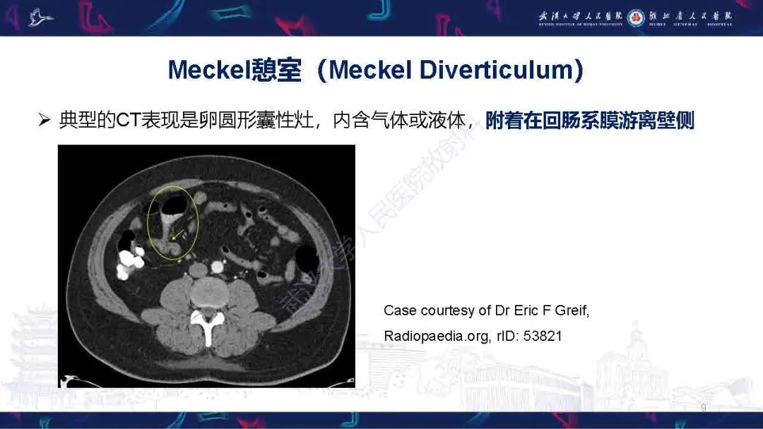 影像PPT - 【PPT】成人先天性回肠异常影像诊断-9