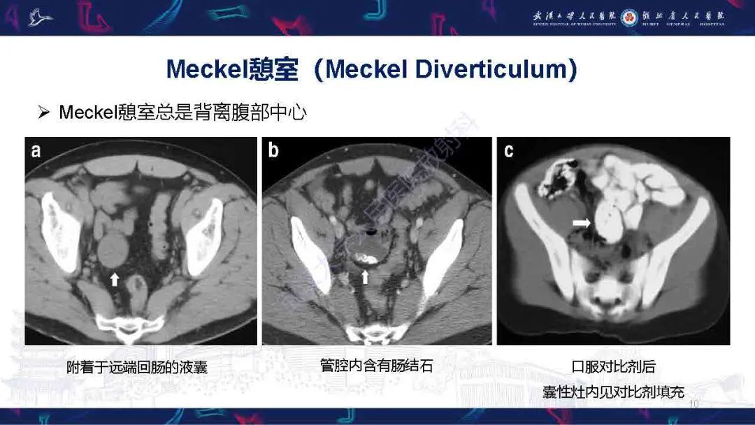 影像PPT - 【PPT】成人先天性回肠异常影像诊断-10