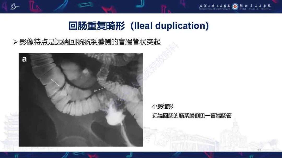 影像PPT - 【PPT】成人先天性回肠异常影像诊断-13