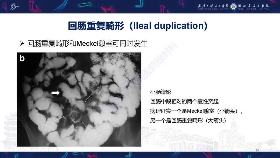 影像PPT - 【PPT】成人先天性回肠异常影像诊断-14