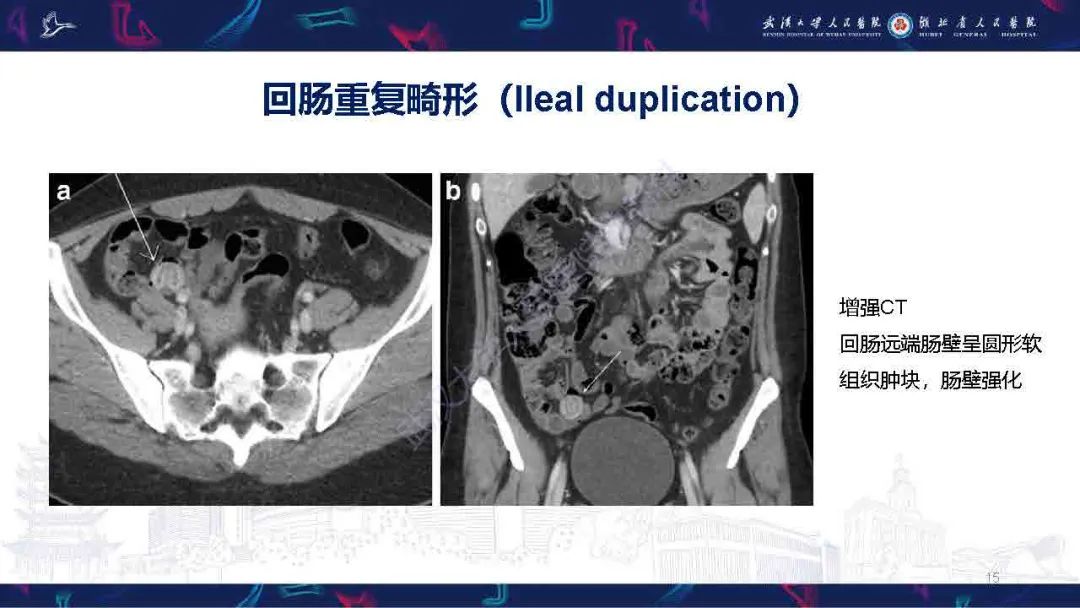 影像PPT - 【PPT】成人先天性回肠异常影像诊断-15