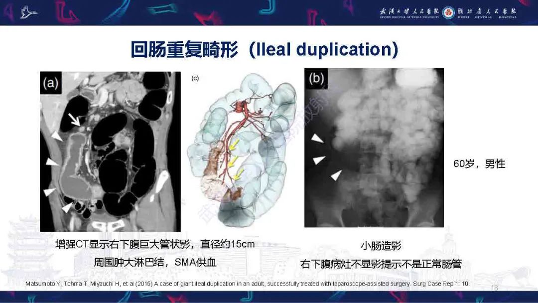 影像PPT - 【PPT】成人先天性回肠异常影像诊断-16