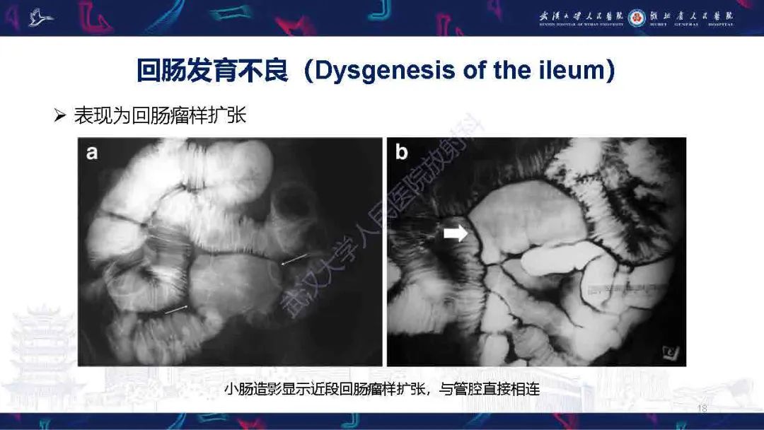 影像PPT - 【PPT】成人先天性回肠异常影像诊断-18