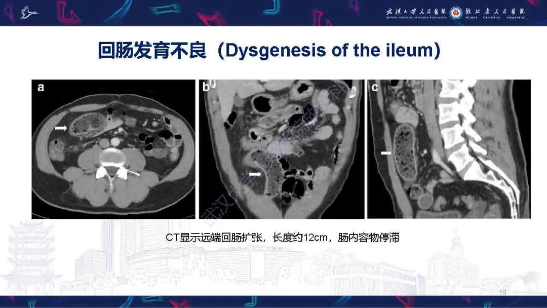 影像PPT - 【PPT】成人先天性回肠异常影像诊断-19