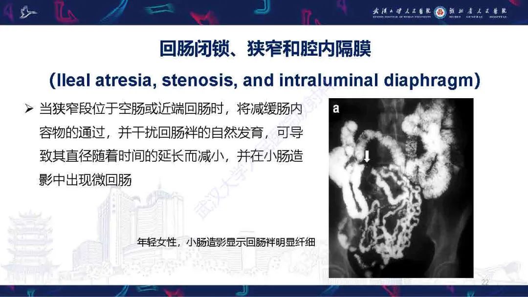 影像PPT - 【PPT】成人先天性回肠异常影像诊断-22