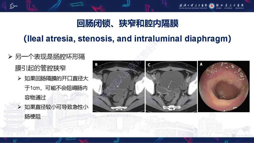 影像PPT - 【PPT】成人先天性回肠异常影像诊断-23
