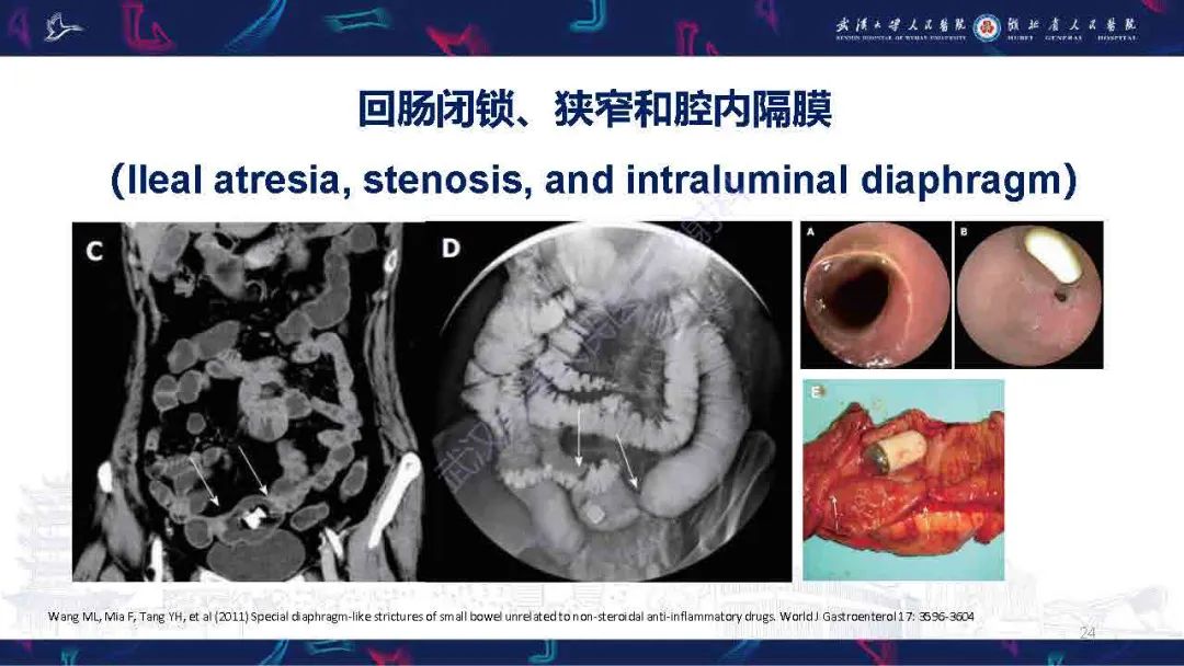 影像PPT - 【PPT】成人先天性回肠异常影像诊断-24