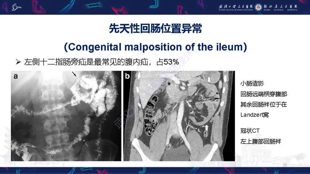 影像PPT - 【PPT】成人先天性回肠异常影像诊断-25