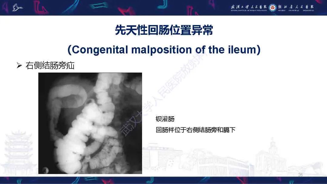 影像PPT - 【PPT】成人先天性回肠异常影像诊断-26