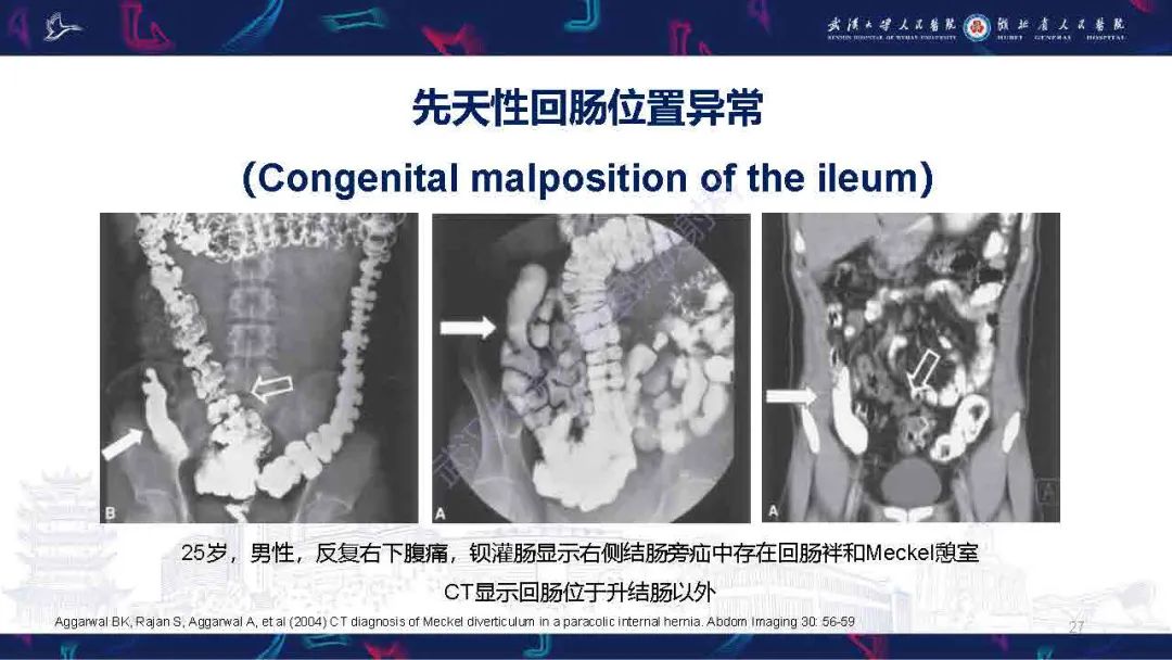 影像PPT - 【PPT】成人先天性回肠异常影像诊断-27