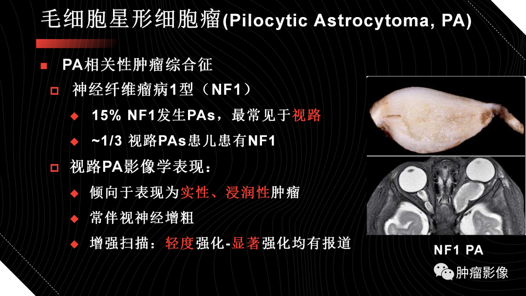 影像PPT - 【PPT】儿童后颅窝肿瘤影像诊断-11