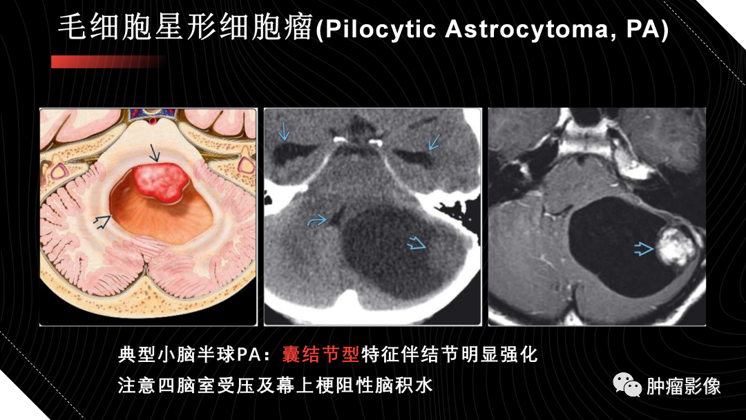 影像PPT - 【PPT】儿童后颅窝肿瘤影像诊断-12