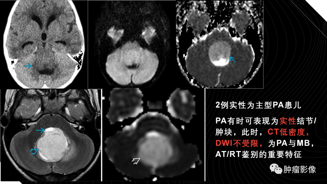 影像PPT - 【PPT】儿童后颅窝肿瘤影像诊断-14