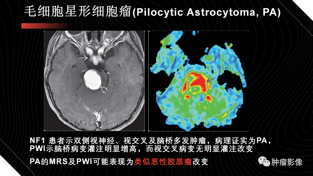 影像PPT - 【PPT】儿童后颅窝肿瘤影像诊断-15