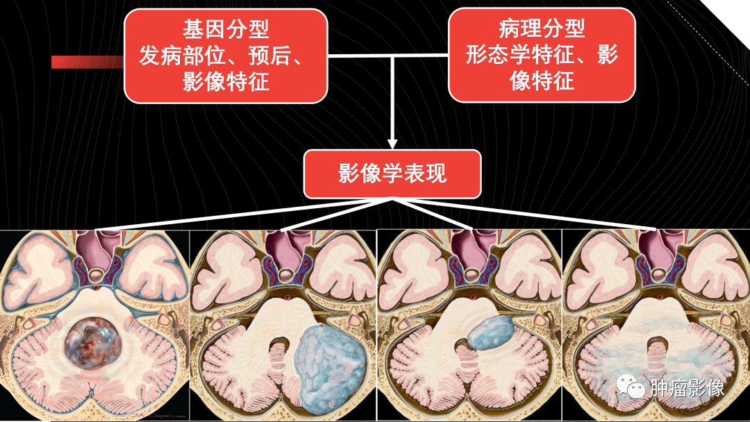 影像PPT - 【PPT】儿童后颅窝肿瘤影像诊断-18