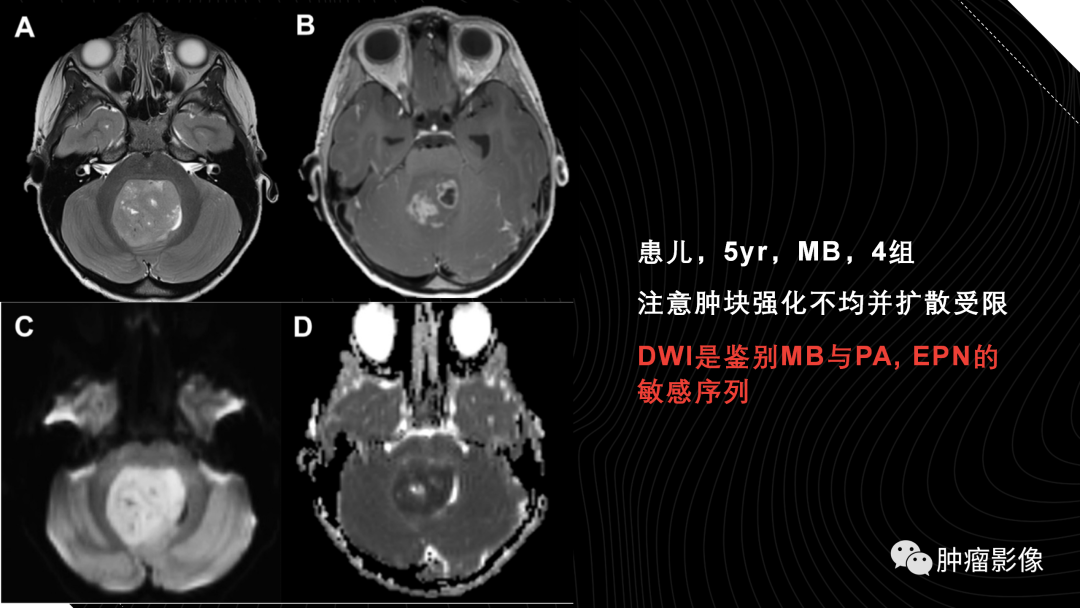 影像PPT - 【PPT】儿童后颅窝肿瘤影像诊断-22