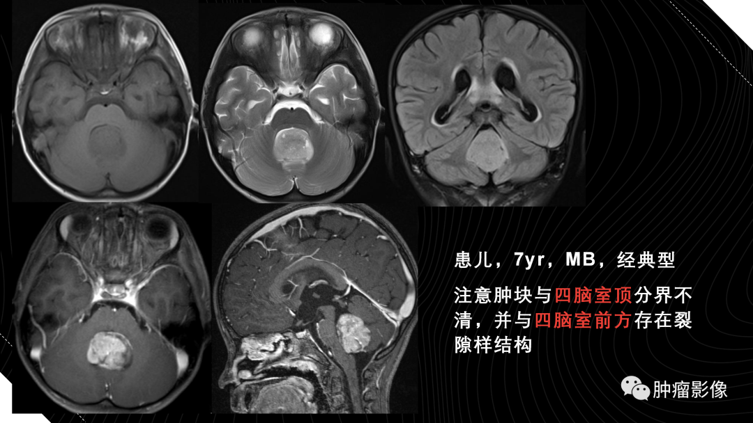 影像PPT - 【PPT】儿童后颅窝肿瘤影像诊断-21