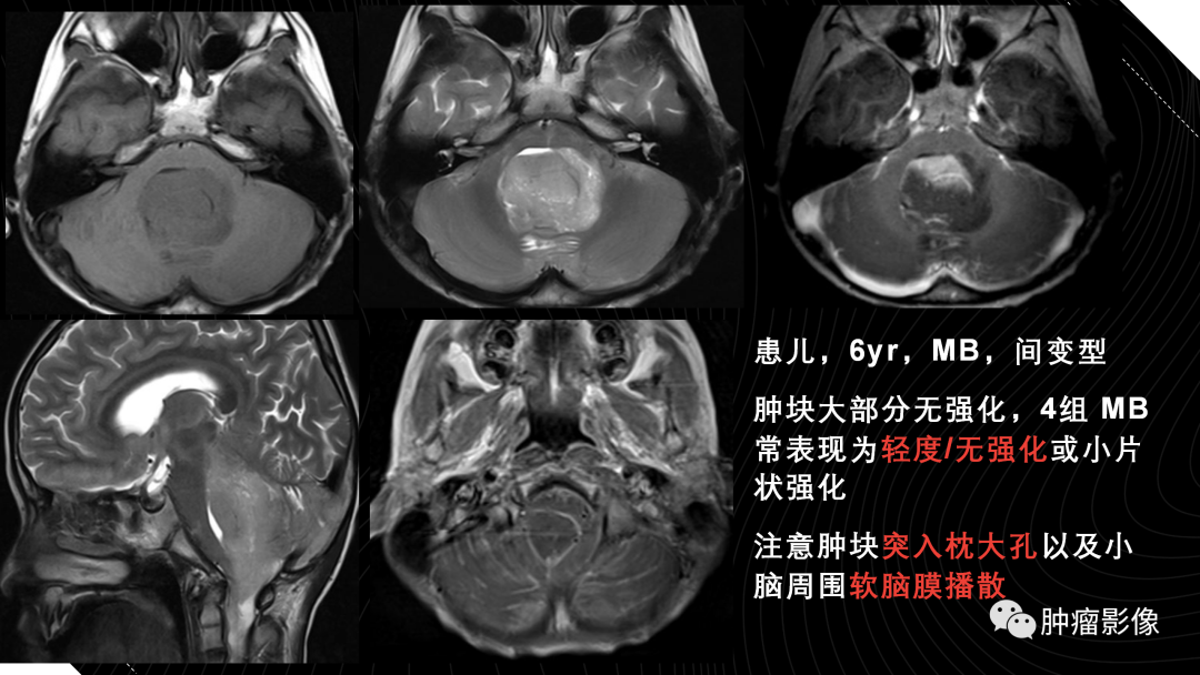 影像PPT - 【PPT】儿童后颅窝肿瘤影像诊断-23