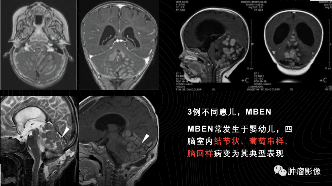 影像PPT - 【PPT】儿童后颅窝肿瘤影像诊断-24