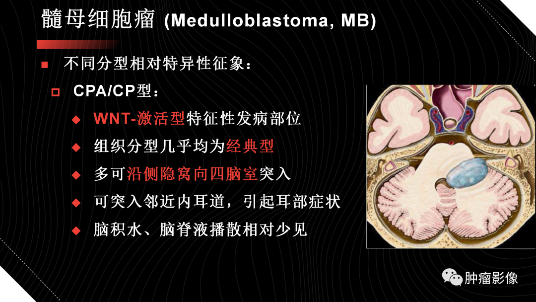 影像PPT - 【PPT】儿童后颅窝肿瘤影像诊断-27