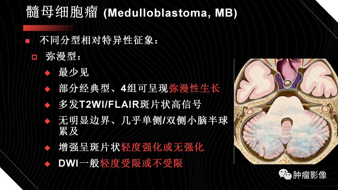 影像PPT - 【PPT】儿童后颅窝肿瘤影像诊断-29