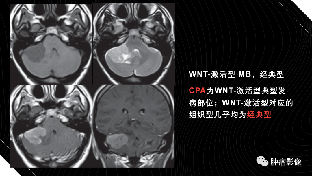 影像PPT - 【PPT】儿童后颅窝肿瘤影像诊断-28