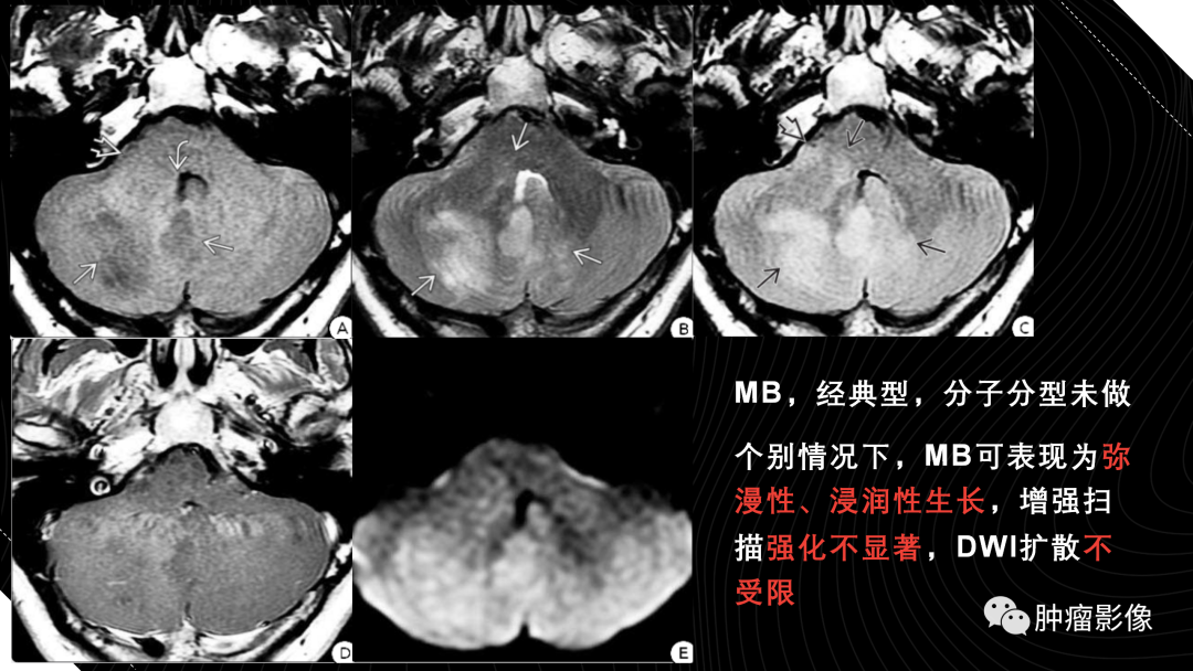 影像PPT - 【PPT】儿童后颅窝肿瘤影像诊断-30