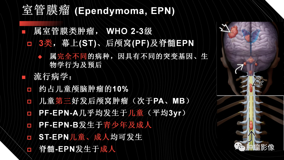 影像PPT - 【PPT】儿童后颅窝肿瘤影像诊断-34