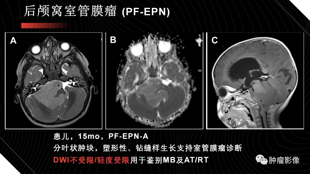 影像PPT - 【PPT】儿童后颅窝肿瘤影像诊断-39