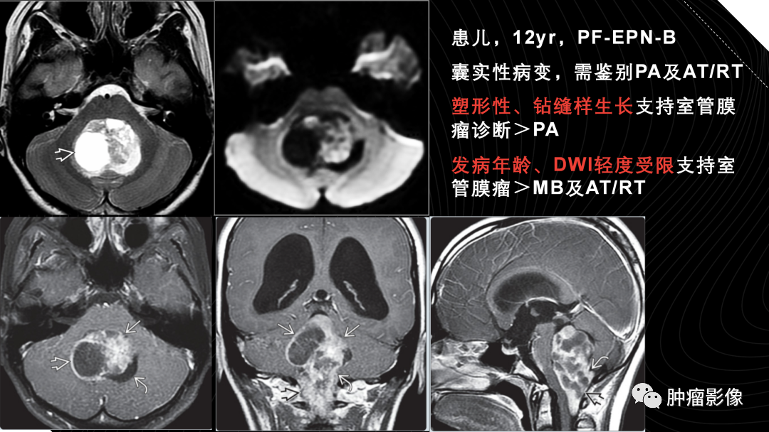 影像PPT - 【PPT】儿童后颅窝肿瘤影像诊断-40
