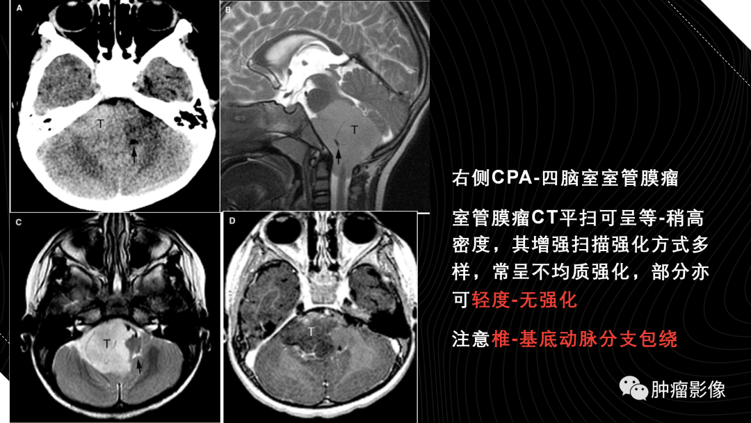 影像PPT - 【PPT】儿童后颅窝肿瘤影像诊断-41
