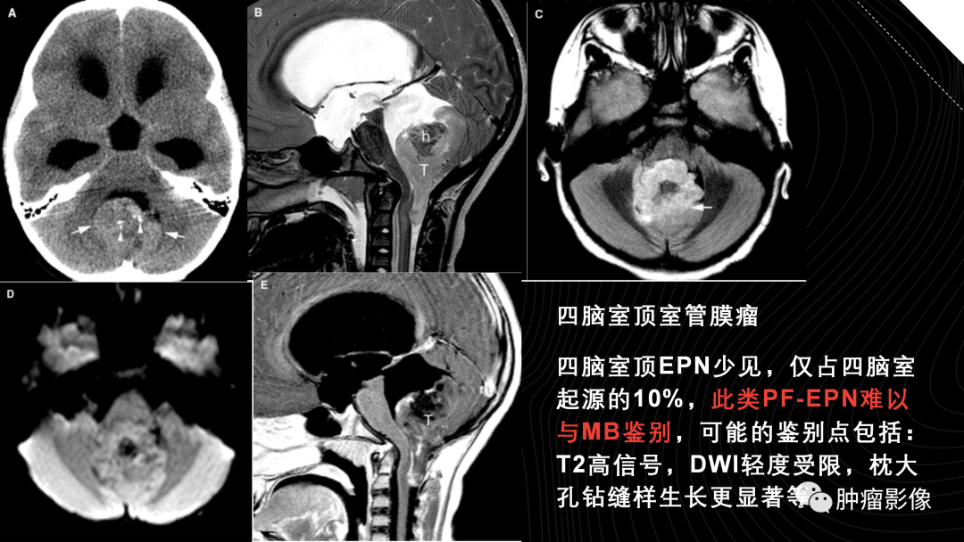 影像PPT - 【PPT】儿童后颅窝肿瘤影像诊断-42
