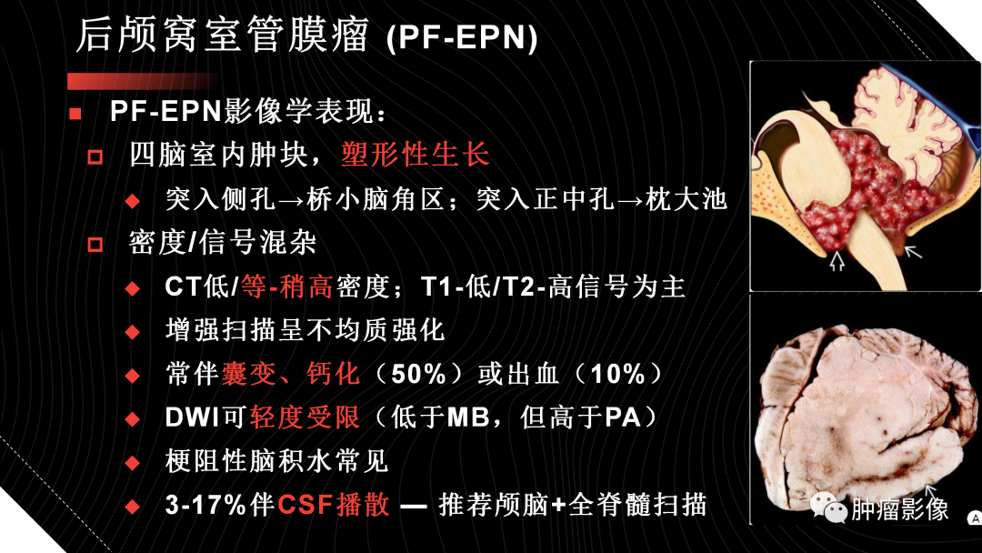 影像PPT - 【PPT】儿童后颅窝肿瘤影像诊断-38