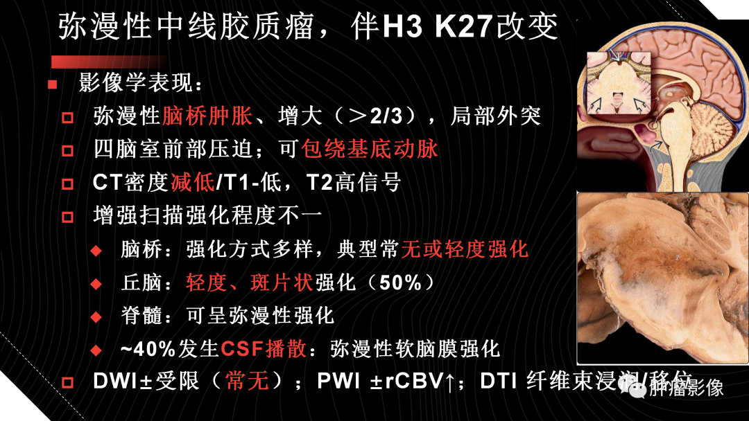 影像PPT - 【PPT】儿童后颅窝肿瘤影像诊断-45