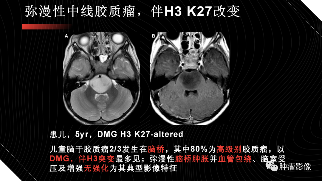 影像PPT - 【PPT】儿童后颅窝肿瘤影像诊断-46