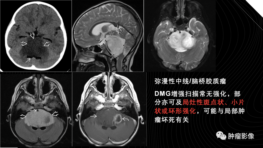 影像PPT - 【PPT】儿童后颅窝肿瘤影像诊断-47