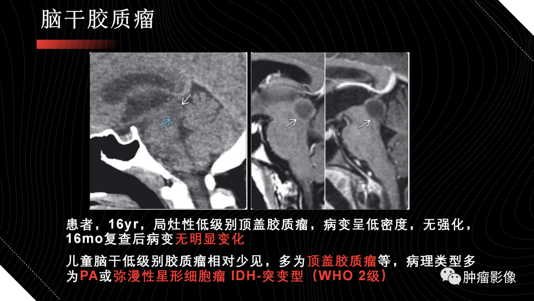 影像PPT - 【PPT】儿童后颅窝肿瘤影像诊断-49
