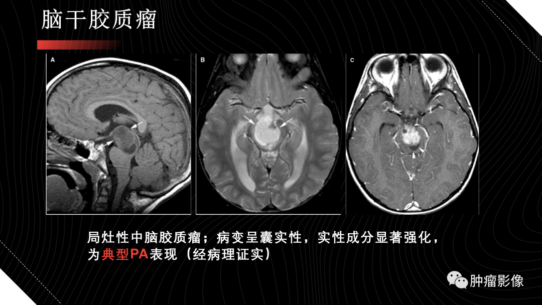 影像PPT - 【PPT】儿童后颅窝肿瘤影像诊断-50