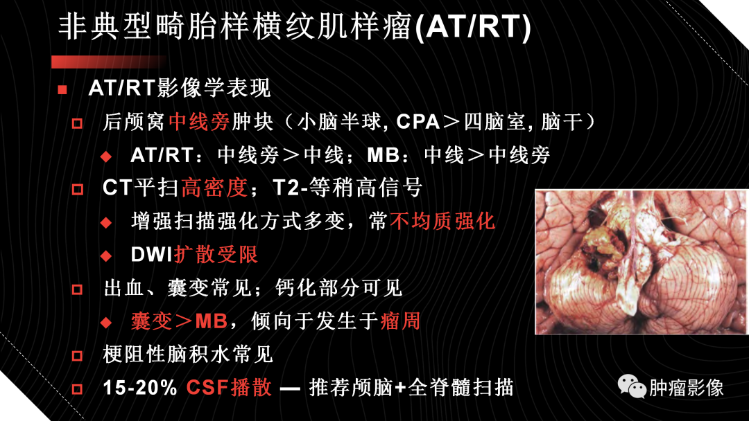 影像PPT - 【PPT】儿童后颅窝肿瘤影像诊断-53