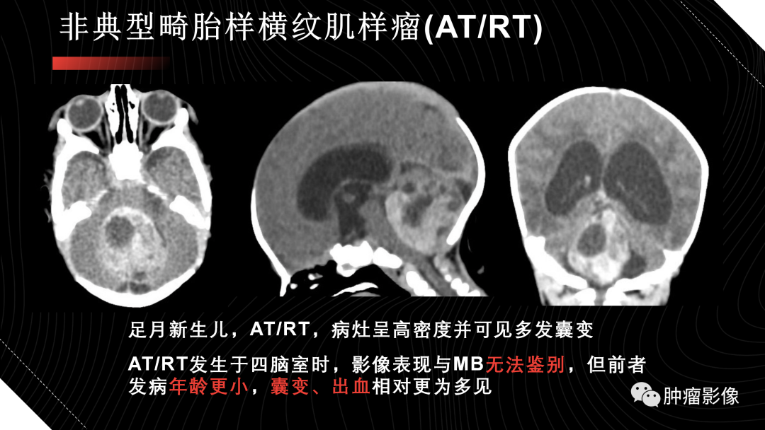 影像PPT - 【PPT】儿童后颅窝肿瘤影像诊断-54