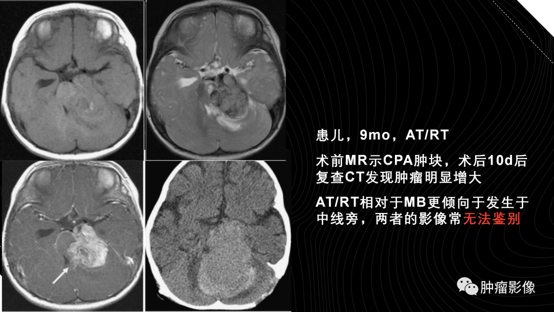 影像PPT - 【PPT】儿童后颅窝肿瘤影像诊断-56