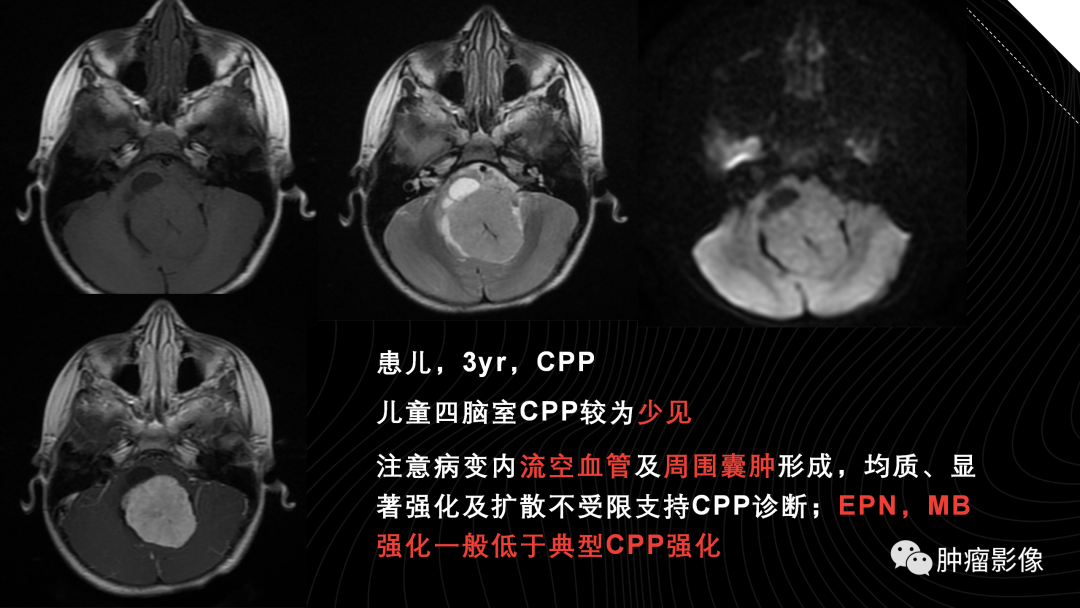 影像PPT - 【PPT】儿童后颅窝肿瘤影像诊断-60
