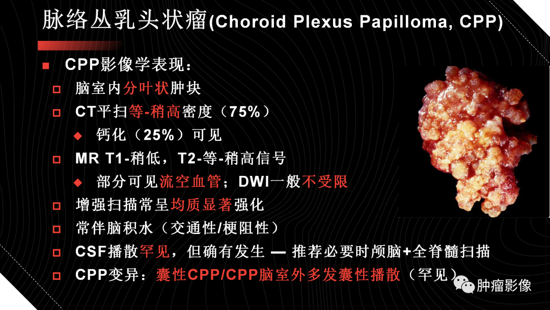 影像PPT - 【PPT】儿童后颅窝肿瘤影像诊断-59